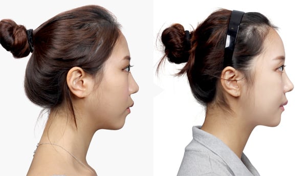 Máy nâng cơ SMAS HIFU