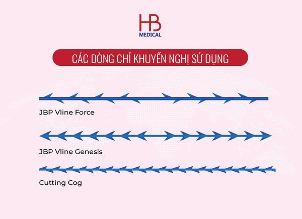 các dòng chỉ tốt để căng chỉ