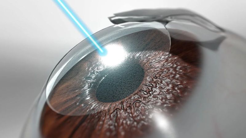 Công nghệ mổ mắt cận thị mới nhất hiện nay chính là Lasik