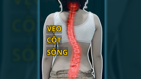 CHỮA VẸO CỘT SỐNG KHÔNG CẦN PHẪU THUẬT!