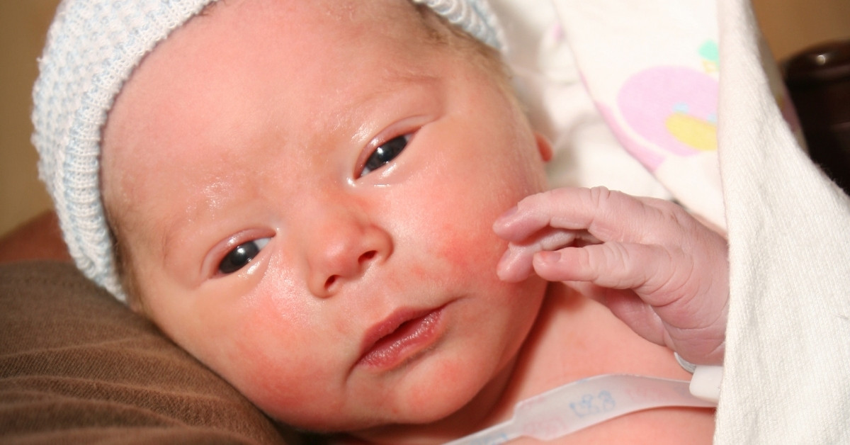 Trẻ sơ sinh thường gặp các bệnh về da