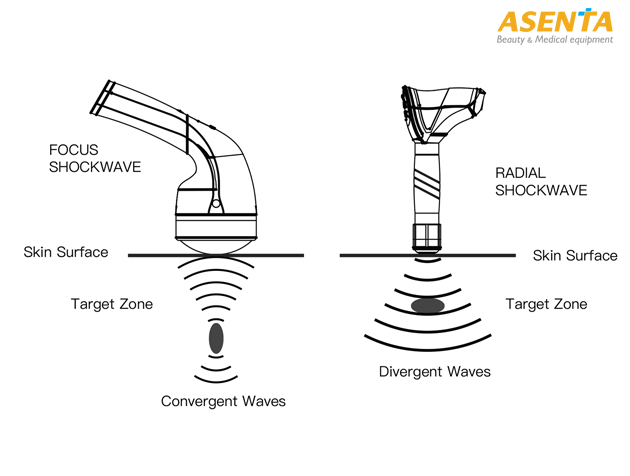So sánh Máy Sóng Xung Kích Focused Shockwave và Radial Shockwave – Ứng Dụng & Đối Tượng Phù Hợp