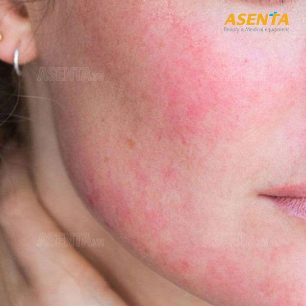 da bị tổn thương không nên dùng máy điện di