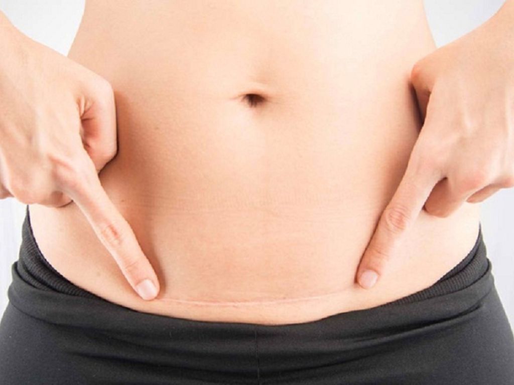 Sau phẫu thuật tạo hình thành bụng, vết sẹo có thể tồn tại ở những người có cơ địa xấu