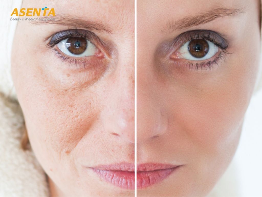 Dùng sóng siêu âm hội tụ HIFU giúp hỗ trợ nâng cơ mặt, xóa mờ nếp nhăn hiệu quả