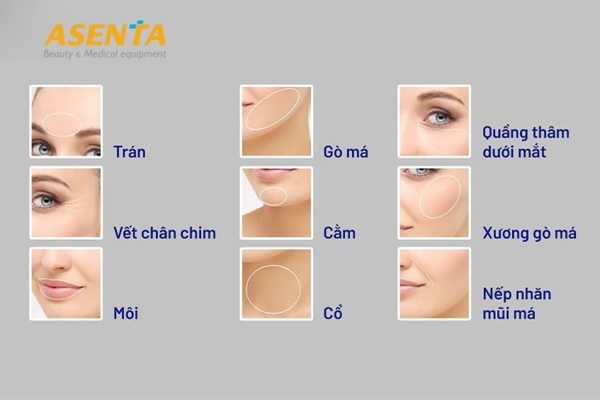 Mỗi một bộ phận sẽ tiêm chất làm đầy phù hợp