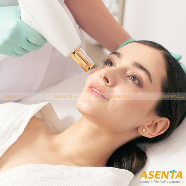 Máy laser xóa xăm còn có chức năng trị nám