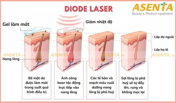 Nguyên lý hoạt động của công nghệ triệt lông Diode Laser