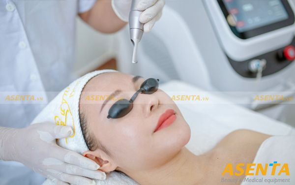 Phương pháp xóa sửa chân mày bằng laser