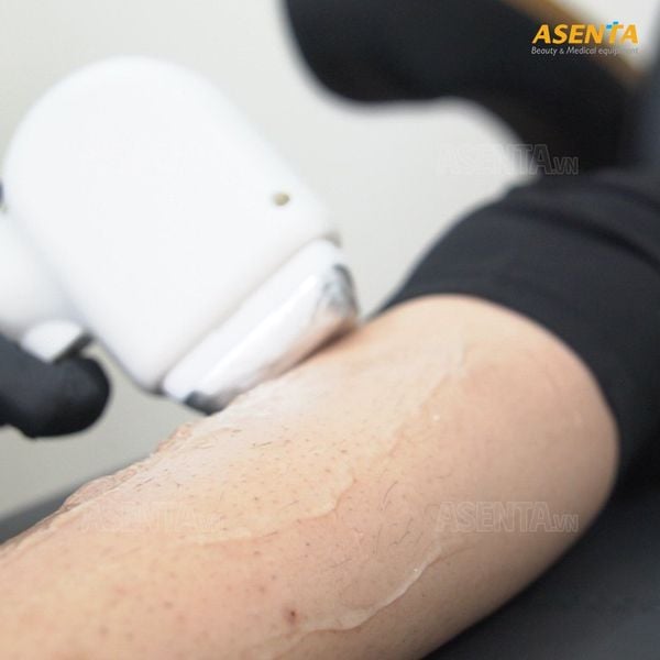 Triệt lông công nghệ cao không đau