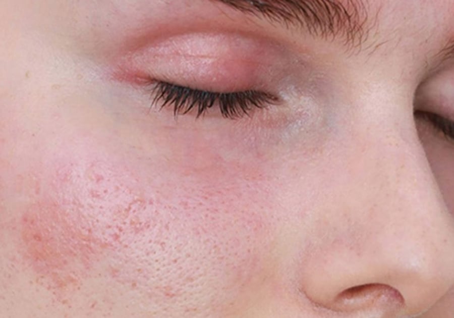 Da mặt bị kích ứng mẩn đỏ phải làm sao? – Dr. Baumann VN