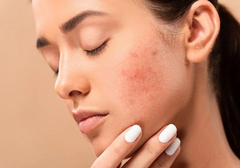 Da mặt bị dị ứng nổi mụn phải làm sao?