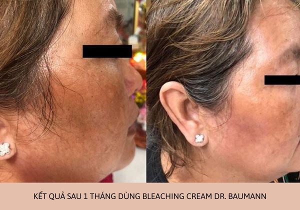 Kết quả trị nám thực tế sau khi dùng Bleaching Cream Dr. Baumann