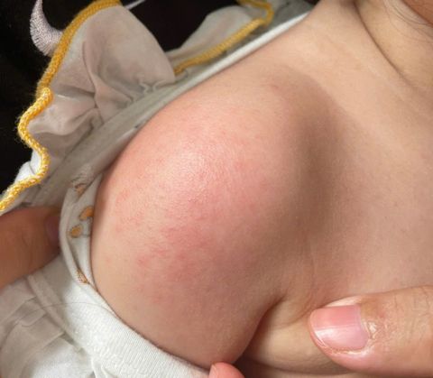 Rôm sẩy là gì, làm sao biết không phải là các dạng phát ban nguy hiểm khác