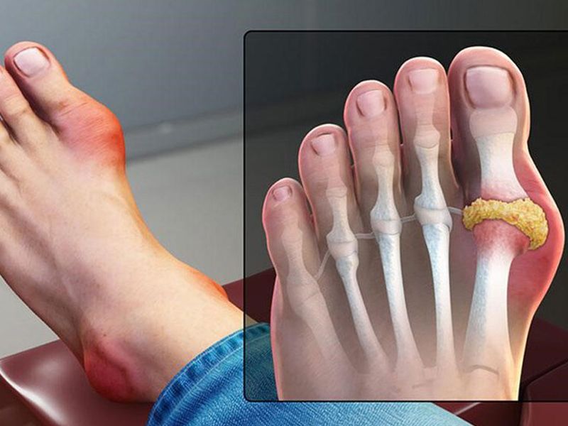 Thuốc chữa bệnh gout thường được chỉ định điều trị