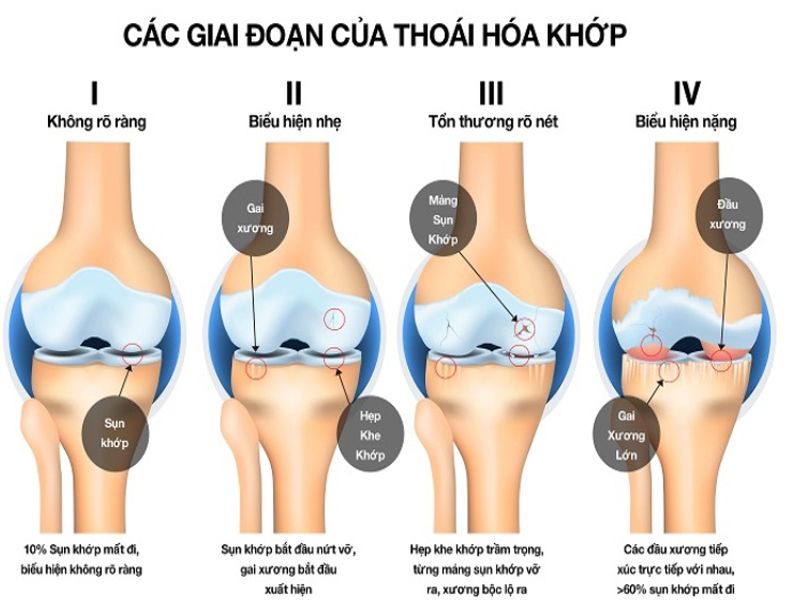 Bệnh Thoái hóa khớp: Nguyên nhân, dấu hiệu, chẩn đoán và điều trị