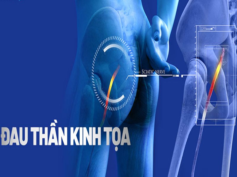 Đau thần kinh tọa: Nguyên nhân, triệu chứng, chẩn đoán và điều trị