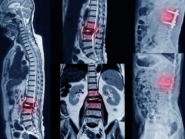 Thoái hóa cột sống: Nguyên nhân, triệu chứng và cách điều trị