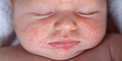 10 bệnh da thường gặp ở trẻ nhỏ