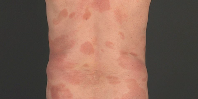 Á vảy nến (parapsoriasis)