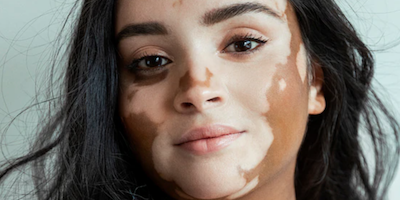 Bệnh bạch biến (vitiligo)