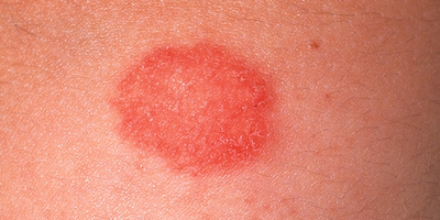 Ban đỏ nhiễm sắc cố định tái phát (fixed drug eruption)