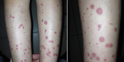 Ban xuất huyết Schonlein- Henoch