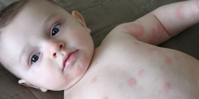 Nổi mề đay ở trẻ sơ sinh