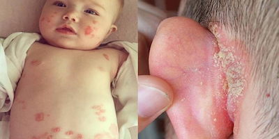 Bệnh vảy nến ở trẻ sơ sinh
