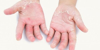 Nguyên nhân và cách chữa bệnh á sừng hiệu quả