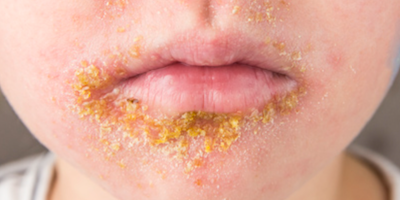 Bệnh chốc (impetigo)