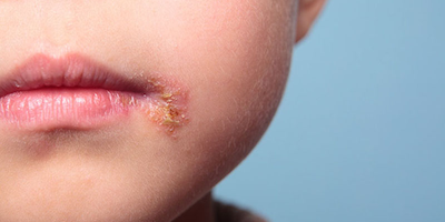 Bệnh chốc lở ở trẻ em: Nguyên nhân & cách điều trị