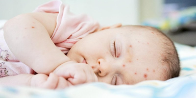 Tổng hợp 15 bệnh về da em bé bố mẹ cần phải biết