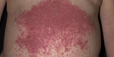 Bệnh Duhring - Brocq (Dermatitis Herpetiformis - DH)