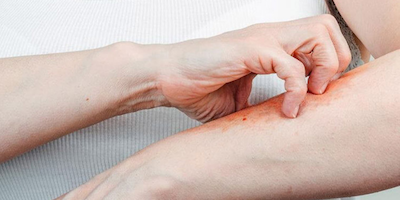 Bệnh ghẻ là gì? Bị ghẻ phải làm sao cho nhanh khỏi?