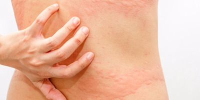 Nổi mề đay: nguyên nhân, dấu hiệu và điều trị