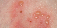Bệnh Pemphigoid và Pemphigus