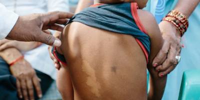 Bệnh phong (leprosy)