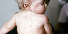 Bệnh sởi (measles/rubeola)