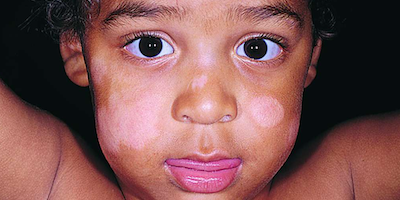 Vảy phấn trắng (pityriasis alba)