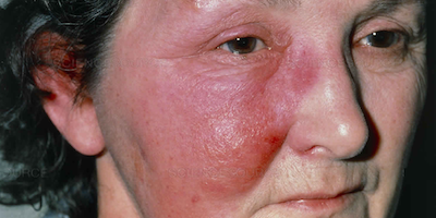 Bệnh viêm quầng (erysipelas)