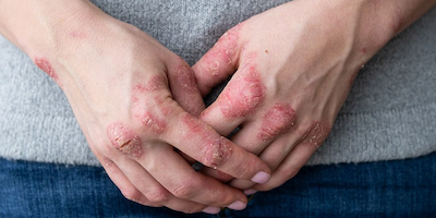 Những nguyên nhân nào gây bệnh chàm da? Phương pháp điều trị bệnh ra sao?