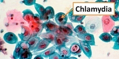 Chlamydia