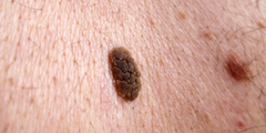 Dày sừng da dầu (seborrhoeic keratosis)
