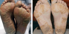 Dày sừng lòng bàn tay bàn chân (palmoplantar keratodermas)