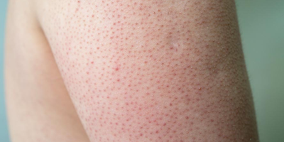 Dày sừng nang lông: Nguyên nhân và cách điều trị hiệu quả