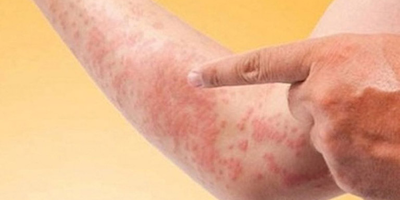 Xử trí khi bị dị ứng thuốc