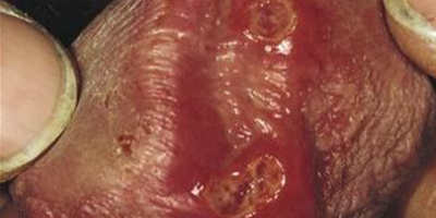 Bệnh hạ cam (chancroid)