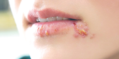 Bệnh mụn rộp (herpes)