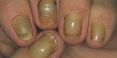 Hội chứng móng tay vàng (yellow nail syndrome)
